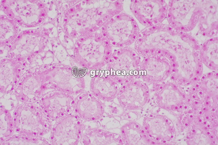 Rejet de greffe de rein x100 - gryphea.org